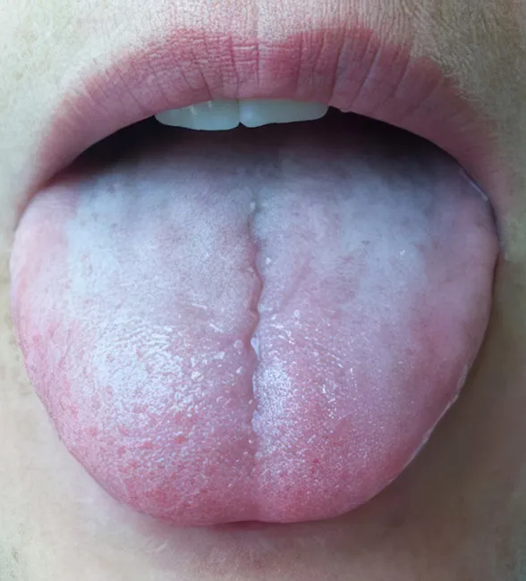 zinamix white tongue layer