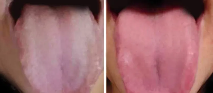 Zinamix before and after results