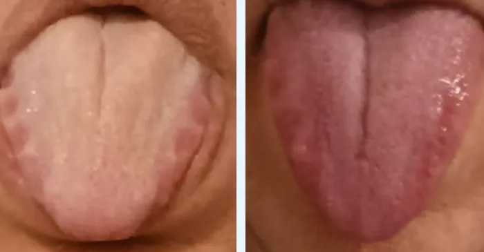 Zinamix before and after